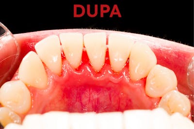 Dupa profilaxie dentara - dinti curati | Dental Hygiene Center