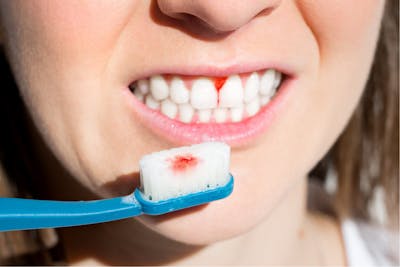 Sangerare gingivala la periaj dentar | Dental Hygiene Center