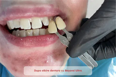 comparatie dinti dupa albire dentara | Dental Hygiene Center