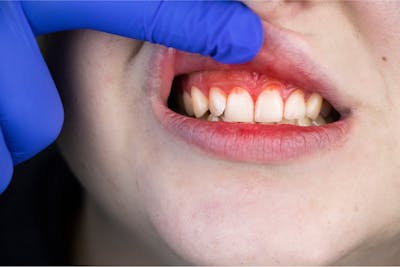 Sangerare gingivala - Boala parodontala - parodontoza | Dental Hygiene Center