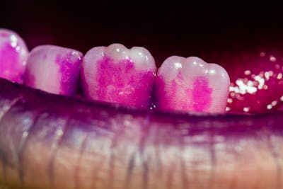 dintii colorati cu revelator de placa bacteriana | Dental Hygiene Center