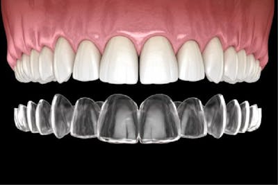 Aparat dentar invizibil Spark  |Dental Hygiene Center