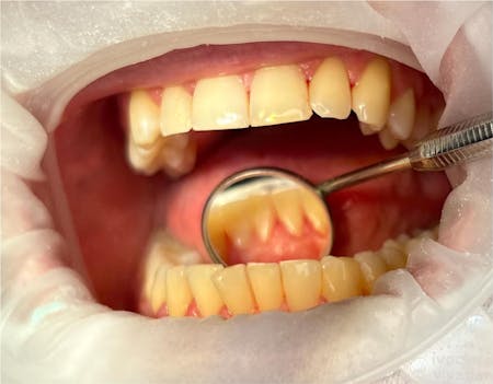 Igienizare dentară - După procedura | Dental Hygiene Center