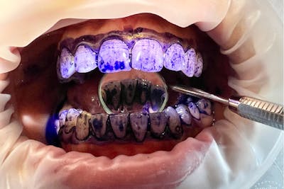 Dinti cu revelator de placa bacteriana protocol gbt | Dental Hygiene Center