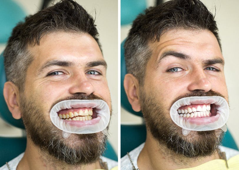 Comparație Inainte și după albire dentară | Dental Hygiene Center