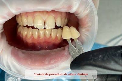 caz 2 - comparatie dinti inainte de albire dentara | Dental Hygiene Center