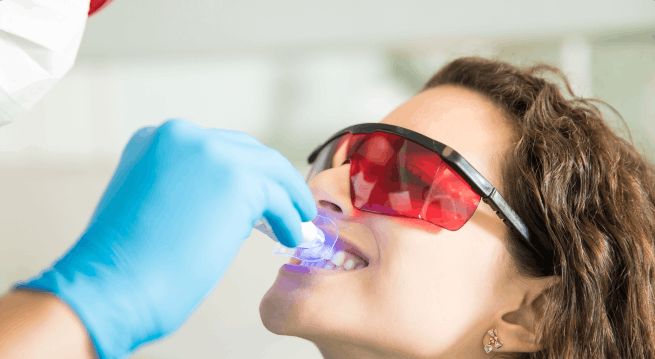 Albire dentară la domiciliu | Dental Hygiene Center