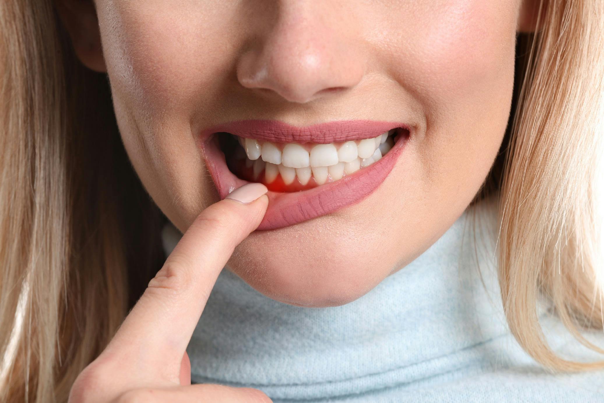 Gingie inflamata parodontoza | Dental Hygiene Center