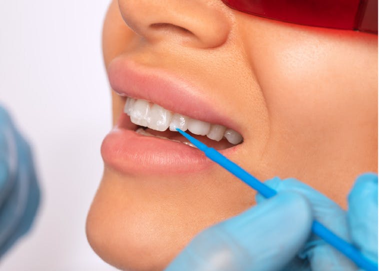 demineralizare dinti | Dental Hygiene Center