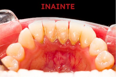 Inainte de profilaxie dentara | Dental Hygiene Center