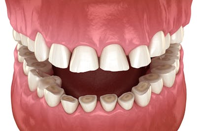 Bruxism - scrisnit din dinti  | Dental Hygiene Center
