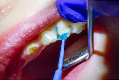 Sigilare dinte copii | Dental Hygiene Center