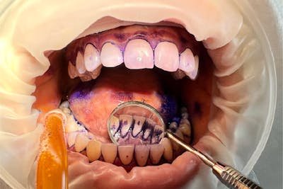 placa bacteriana inainte de airflow gbt | Dental Hygiene center