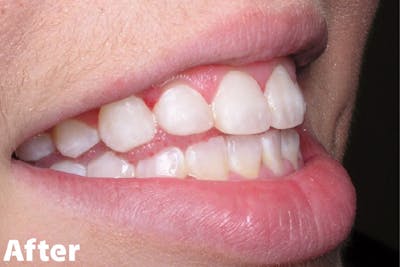 dinti remineralizati - dupa procedura | Dental Hygiene Center