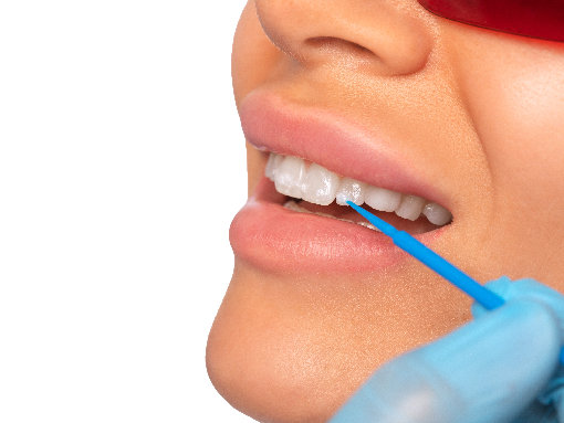 tratament demineralizare dinti | Dental Hygiene Center