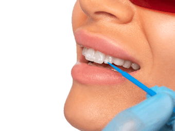 tratament demineralizare dinti | Dental Hygiene Center