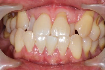 Dinți cu retractie gingivala | Dental Hygiene Center