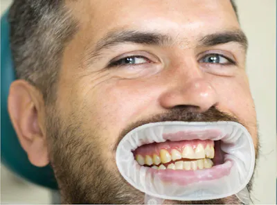 Albire before and after - Dental Hygiene Center