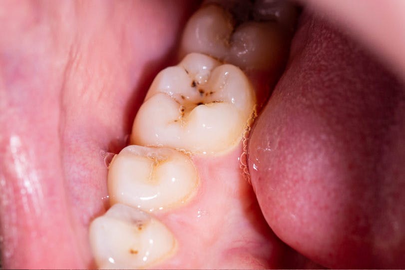 Pete negre pe dinti | Dental Hygiene Center