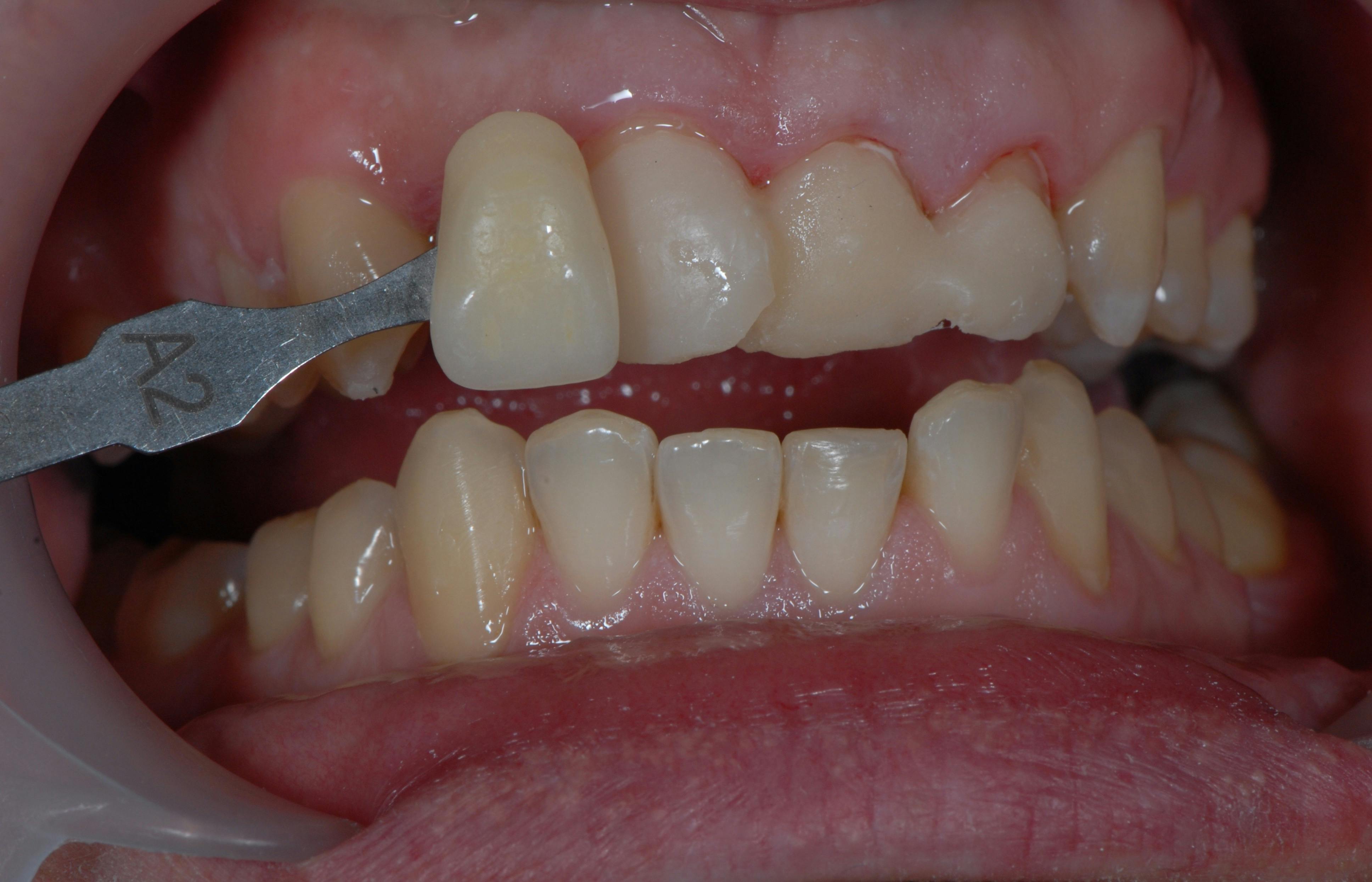 Fațete dentare Etapa 2