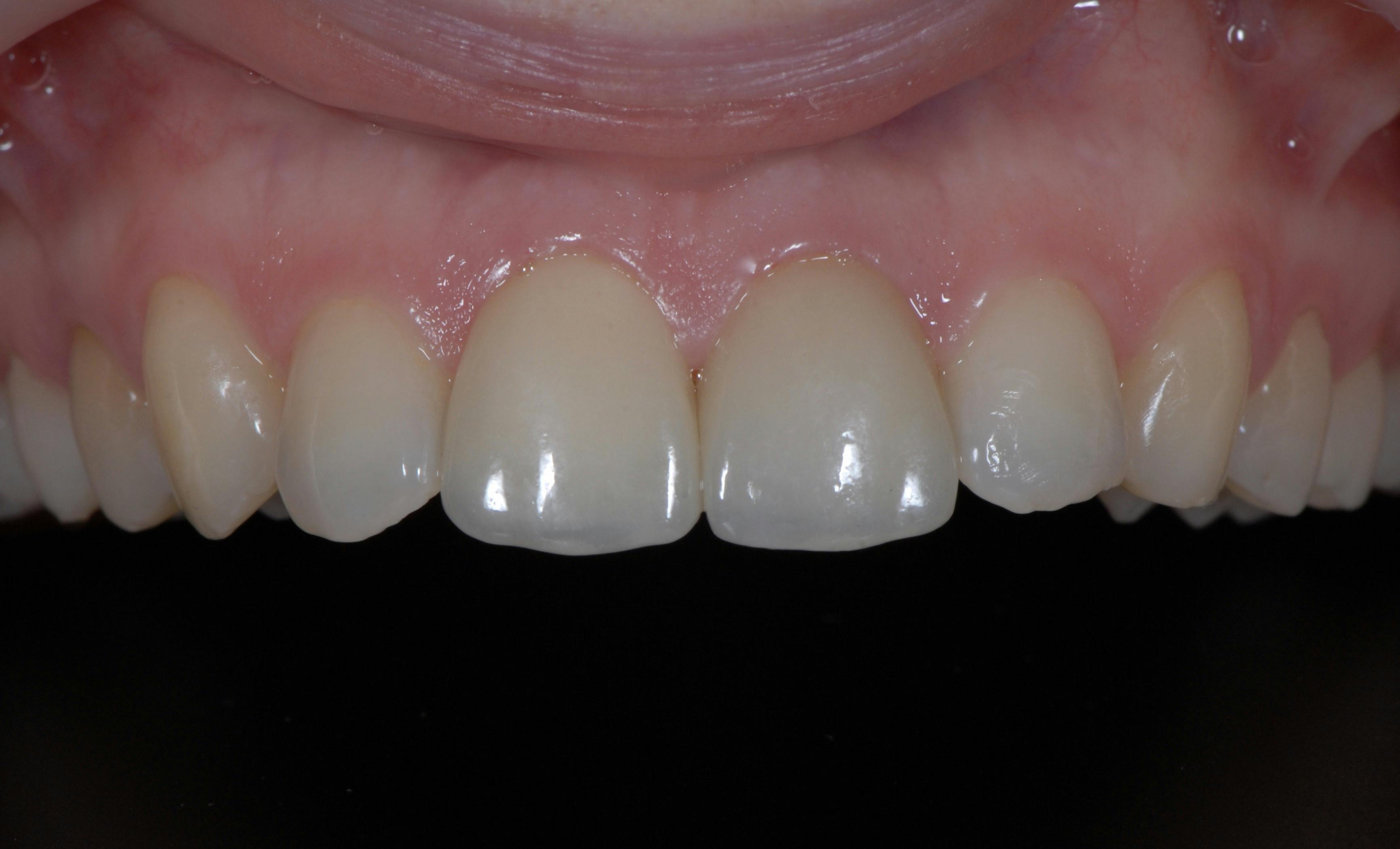 Fațete dentare DentoArt Galați Etapa 2