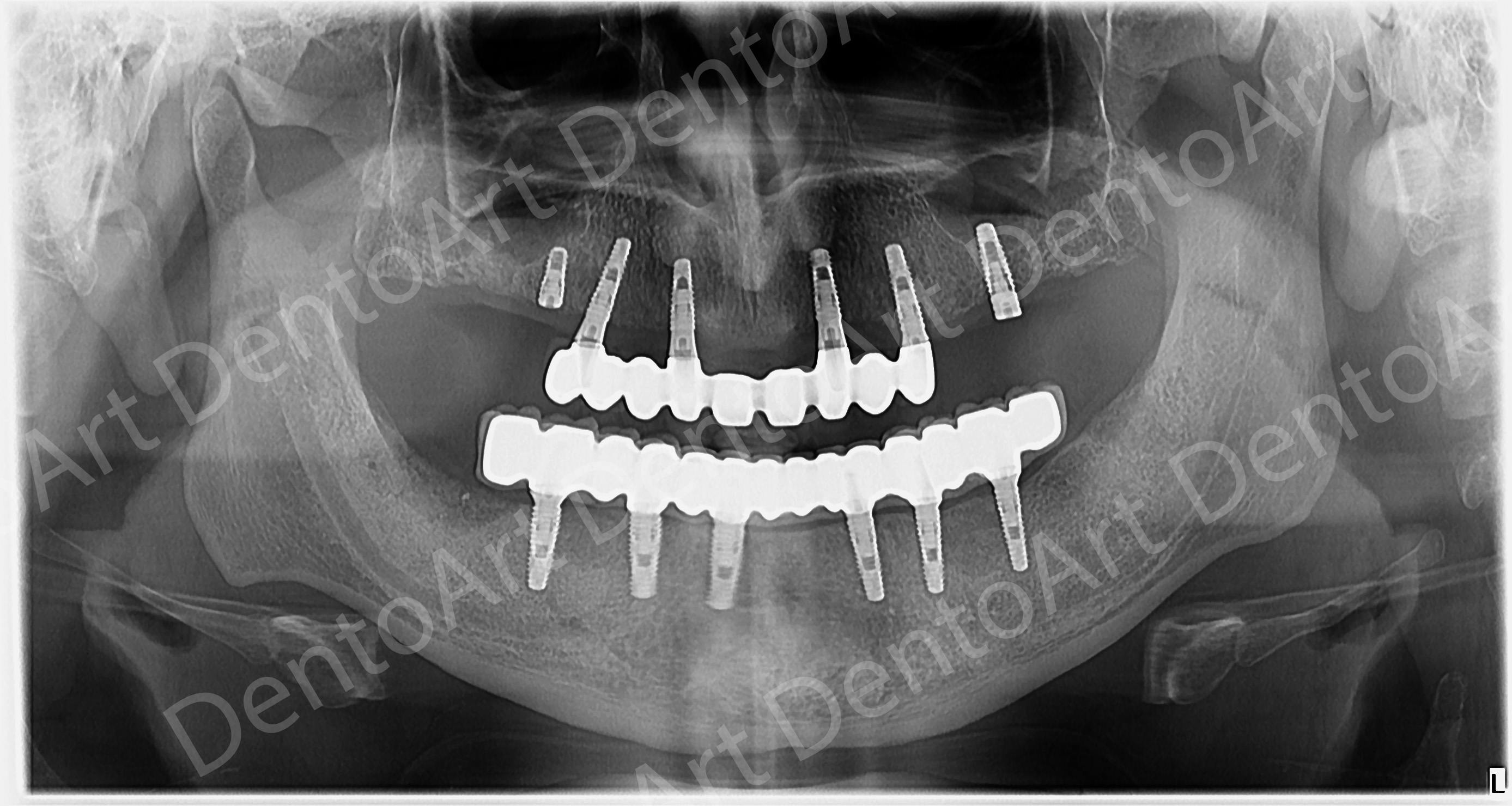 Reabilitare complexă pe implanturi realizată la DentoArt Galati în 24 de ore