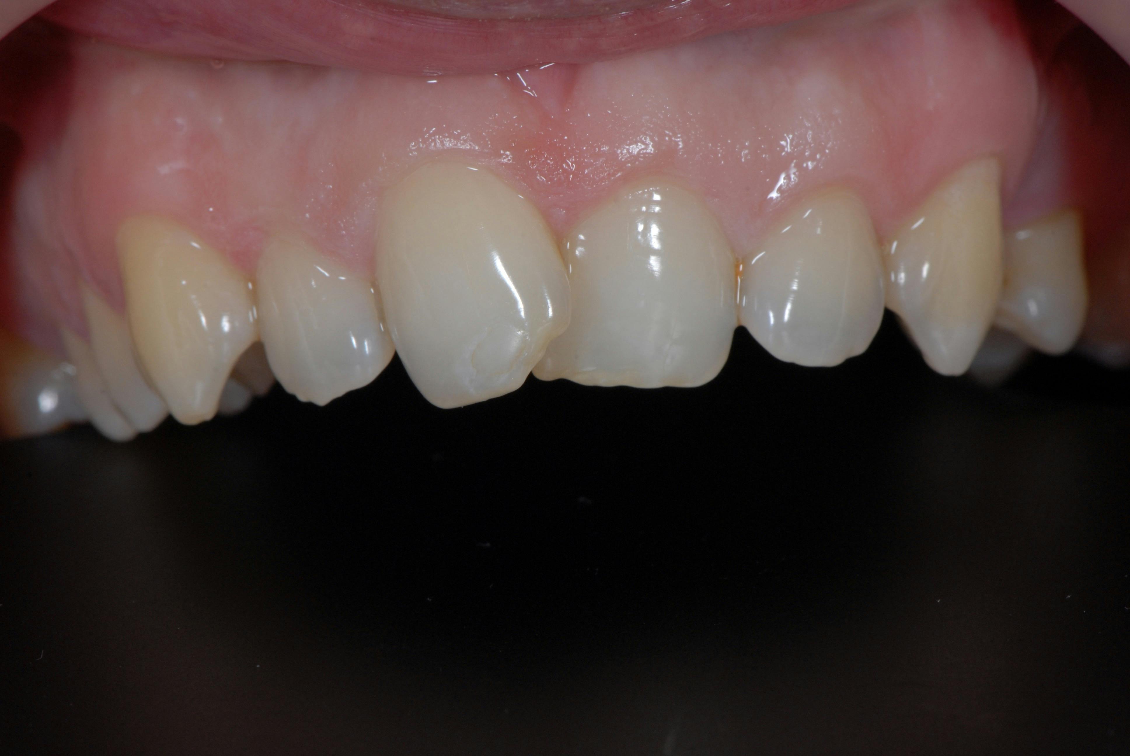 Fatete dentare DentoArt Etapa 1