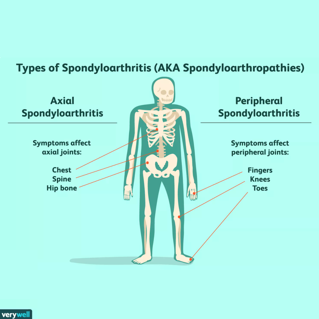 A Guide to Axial Spondyloarthritis