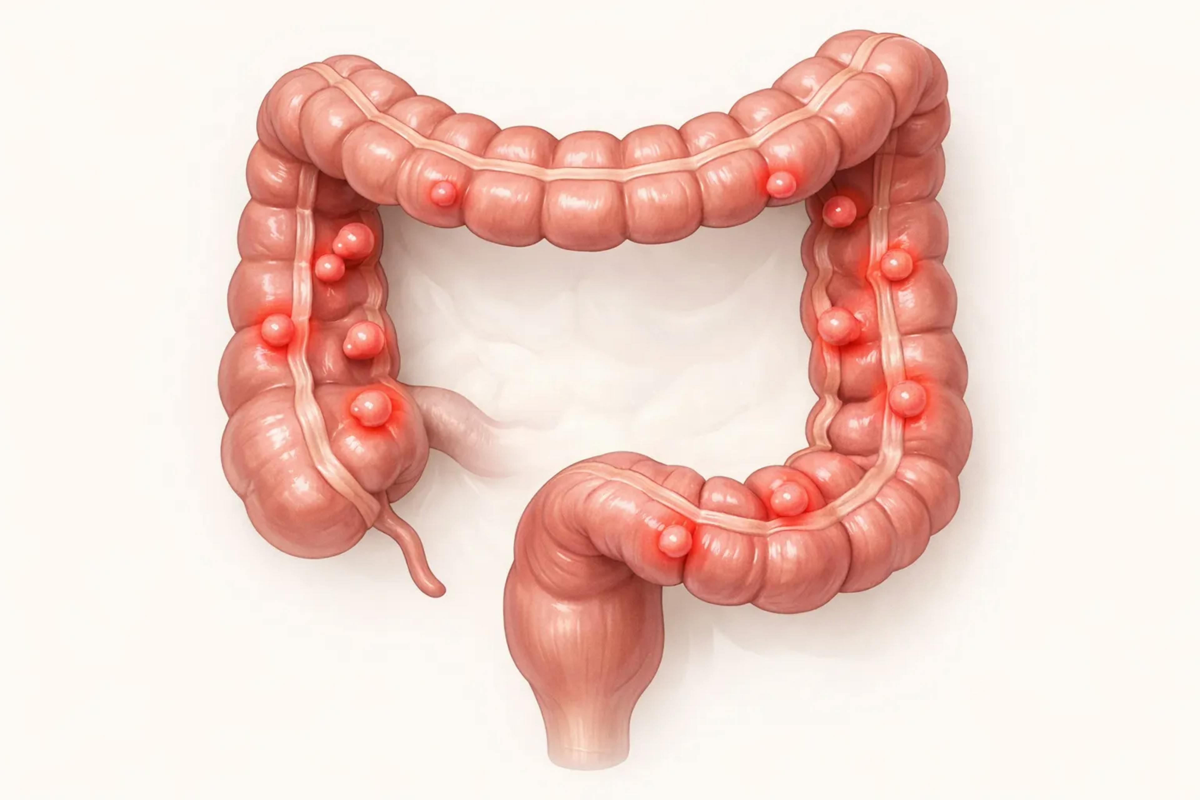 Πολύποδες Παχέος Εντέρου