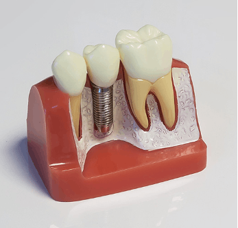 3D geplante Implantologie