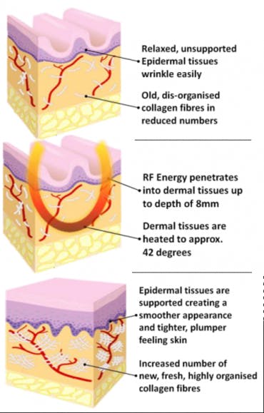 Radio Frequency Skin Tightening 