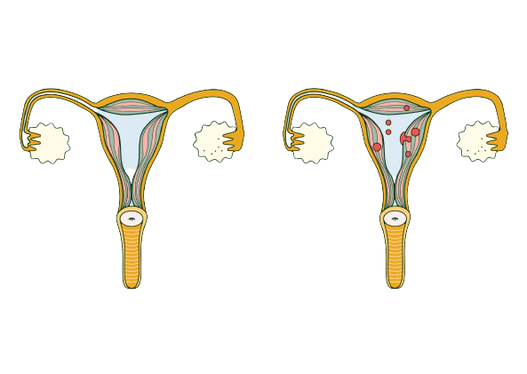 adenomyosis-painful-periods