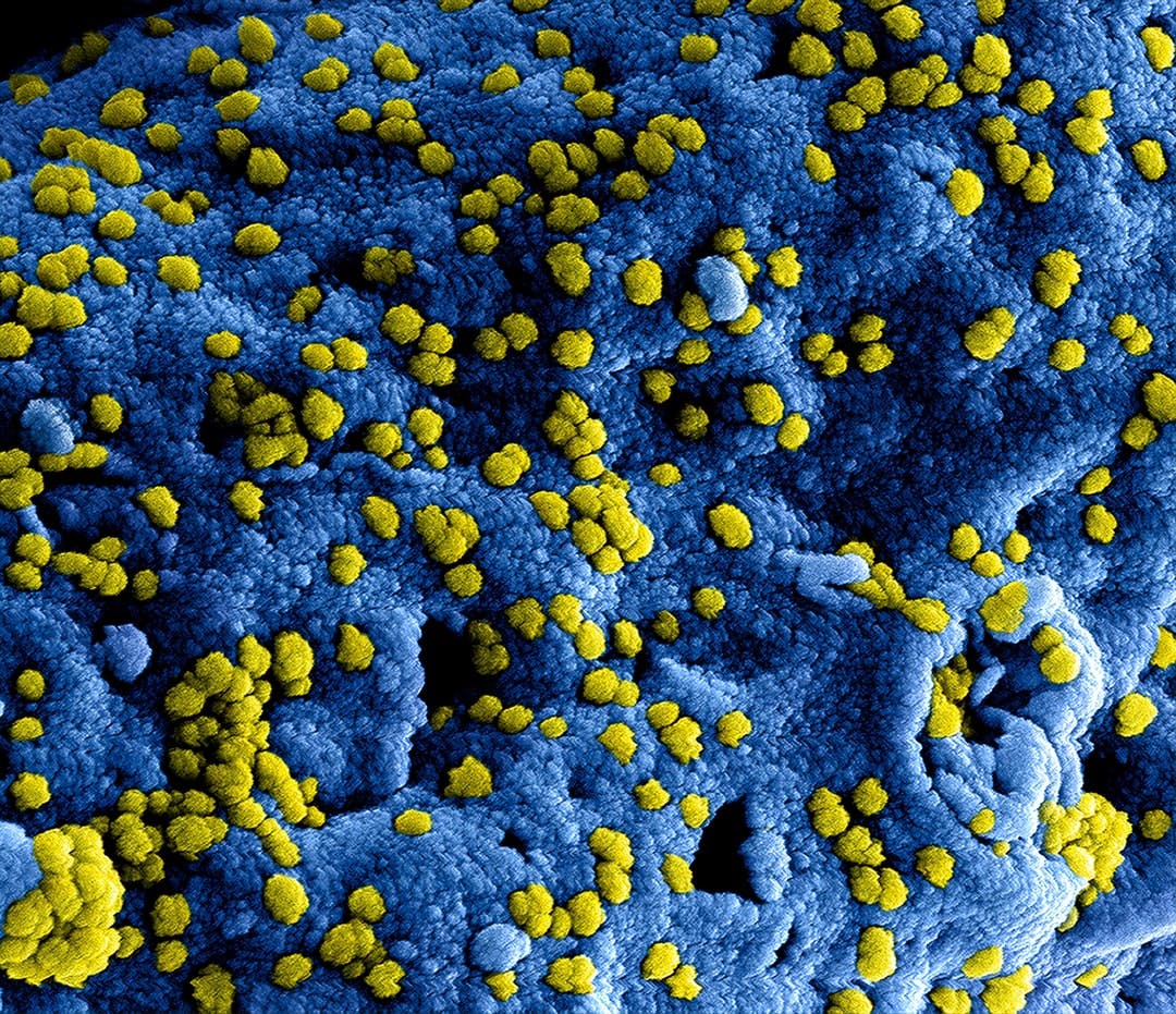Produced by the National Institute of Allergy and Infectious Diseases NIAID this highly magnified digitally colorized scanning electron microscopic SEM image revealed ultrastructural details at the site of interaction of numerous yellow colored Middle East respiratory syndrome coronavirus MERSCoV viral particles located on the surface of a Vero E6 cell which had been colorized blue