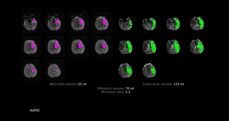 MRI Mismatch analysis using RapidAI