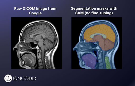 Image displaying brain MRI with and without segmentation masks produced by Segment Anything (SA)