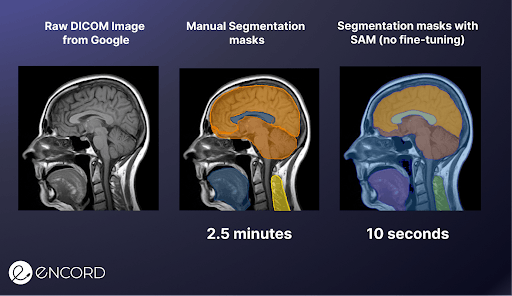 Image displaying manually produced vs. SAM-produced segmentation masks on a brain MRI scan