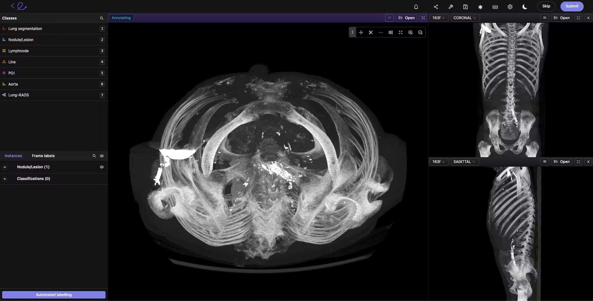 Example of annotated medical image in Encord.