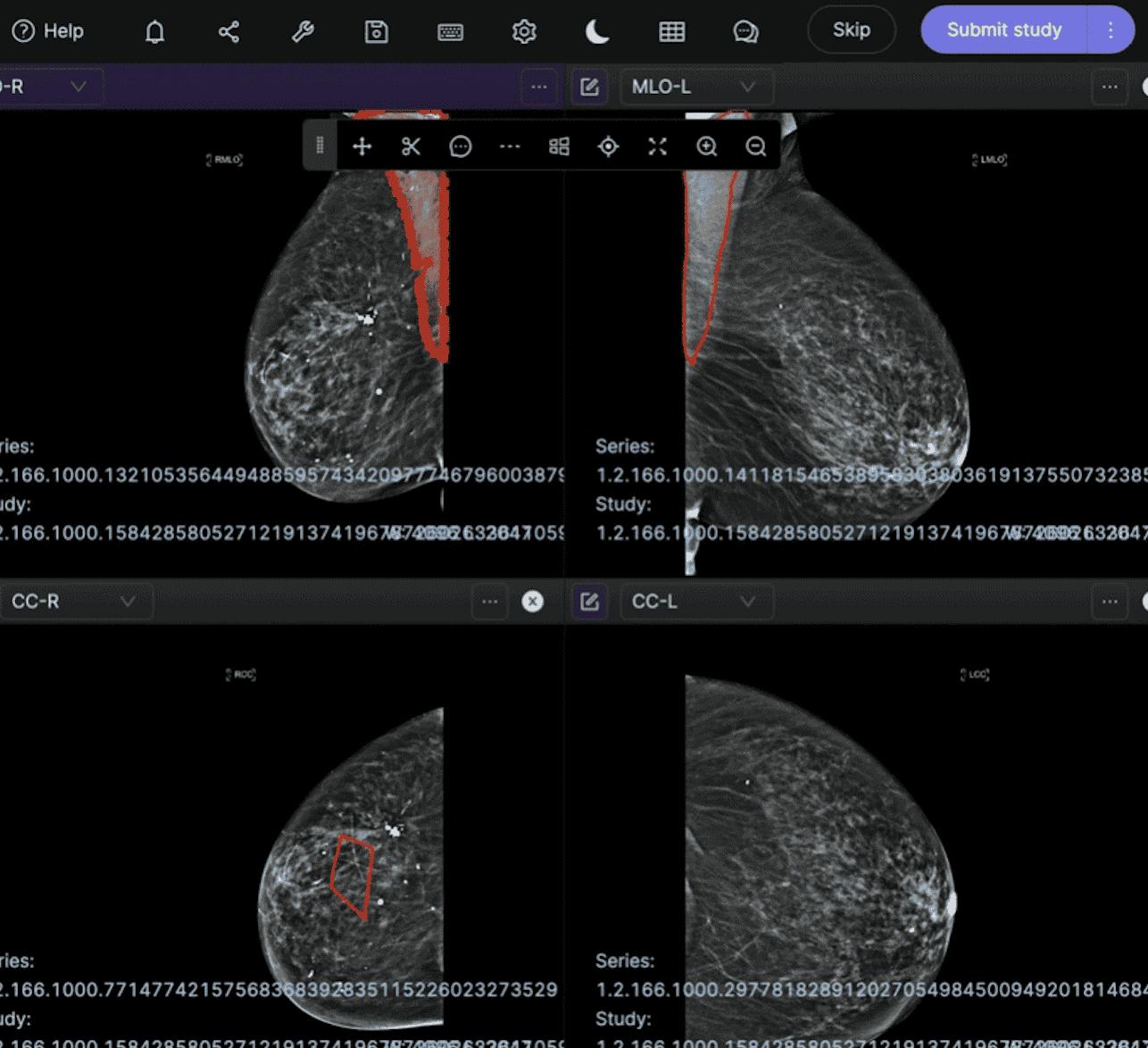 screenshot of mamogram in encord dicom annotation platform