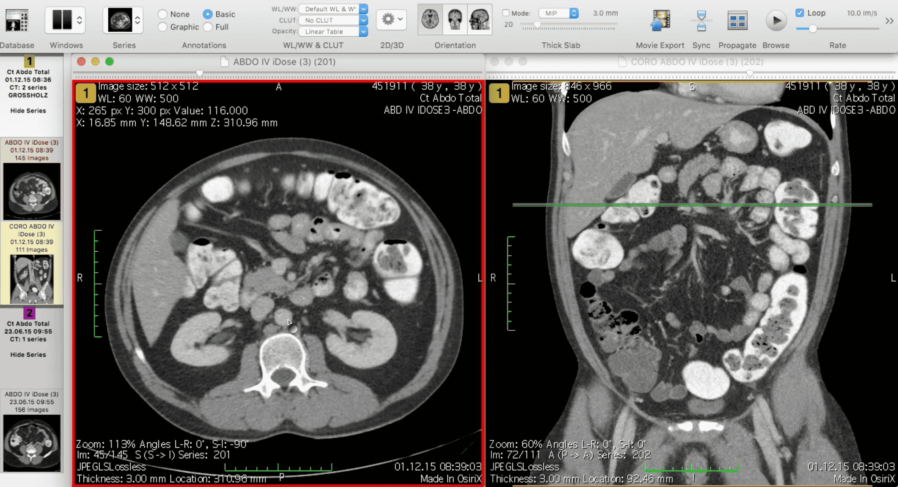 OsiriX DICOM annotator