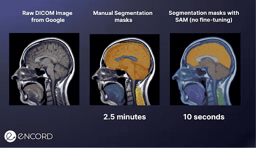 Auto annotations using SAM model on DICOM images in Encord Platform