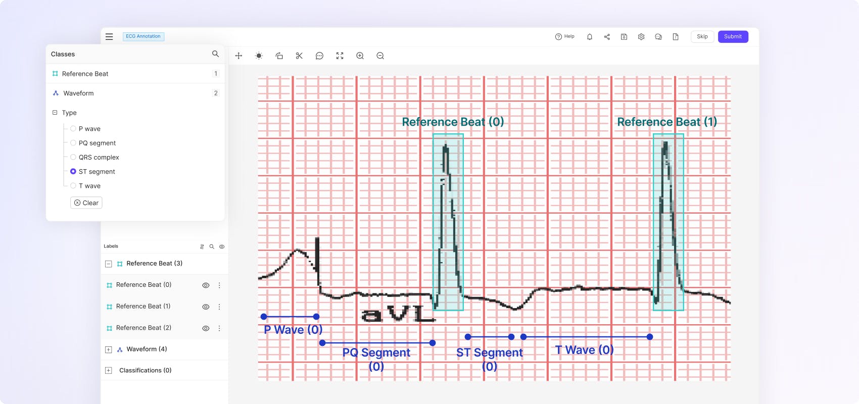 ECG annotation