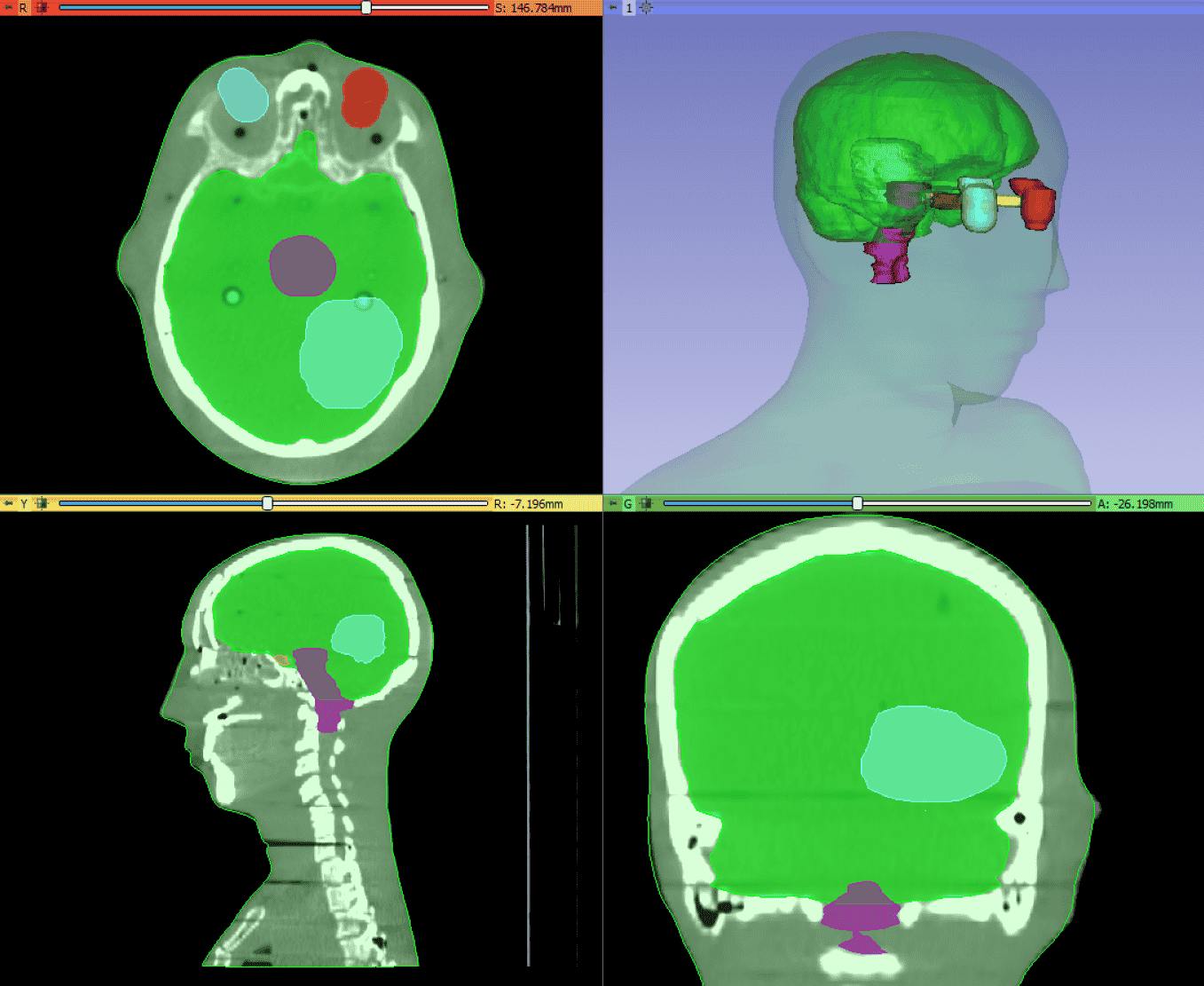 example of image segmentation on 3D slicer