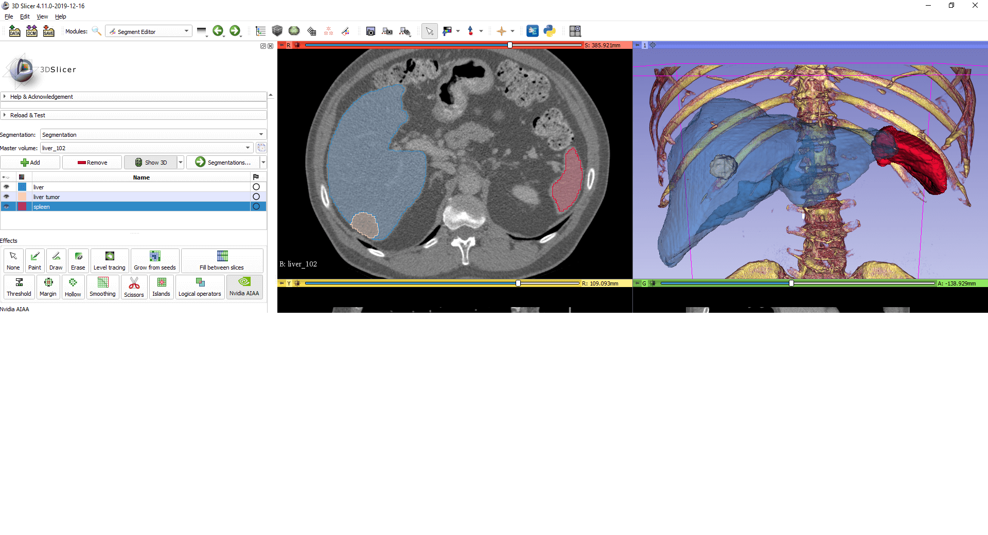 3D Slicer AI-assisted Segmentation