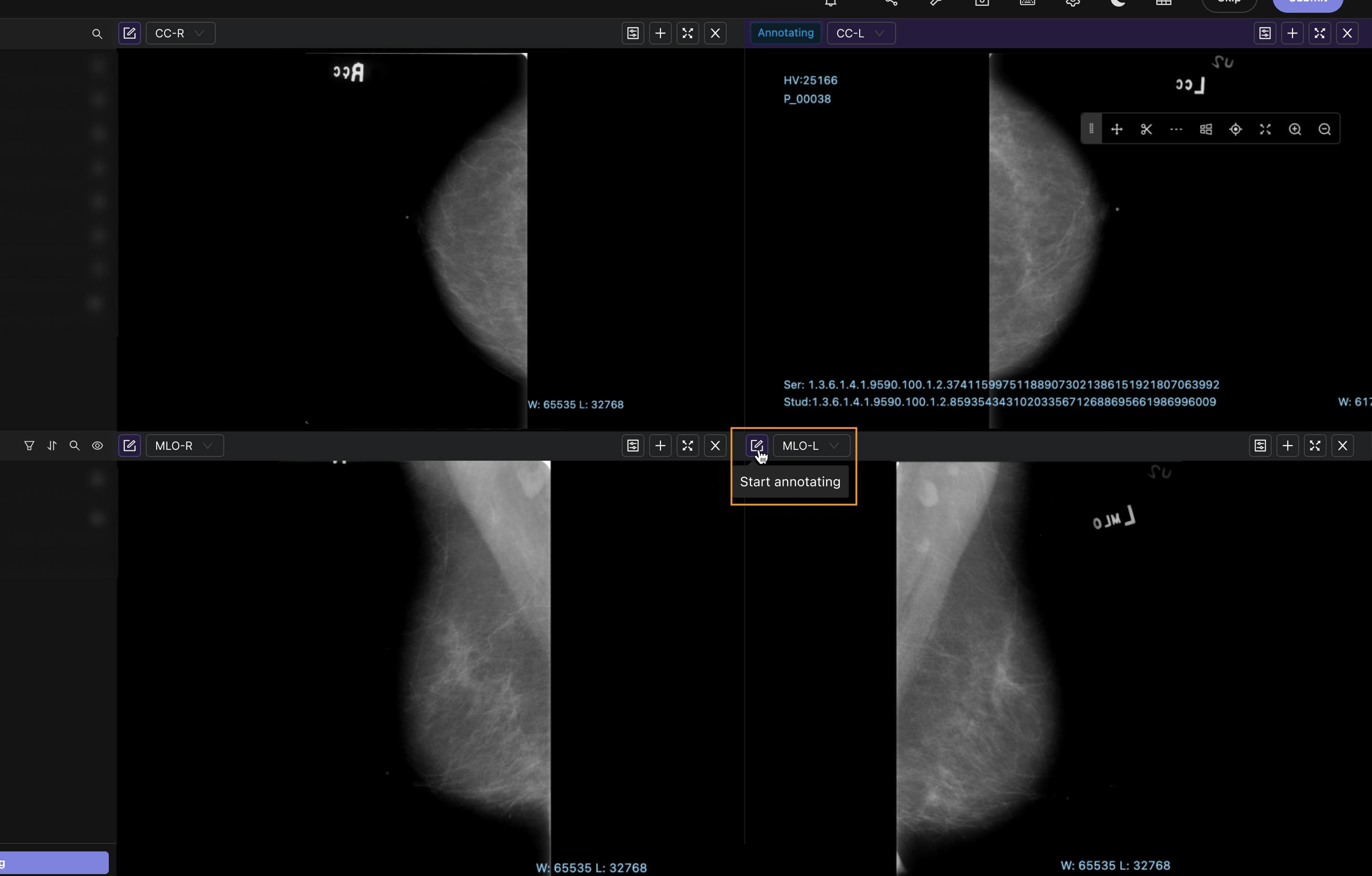 Mammogram still images in DICOM viewer