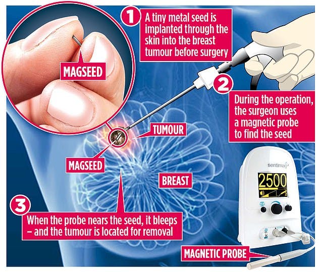 Graphic showing the Magseed® marker within a breast tumour