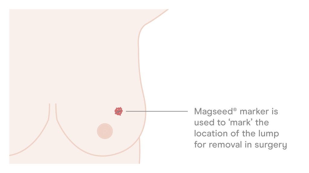 Illustration of Endomag's Magseed marker used to mark location of breast lesion for removal