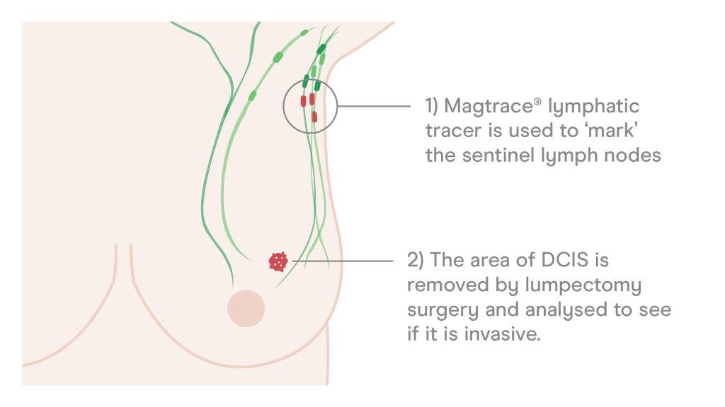 delayed sentinel lymph node biopsy illustration