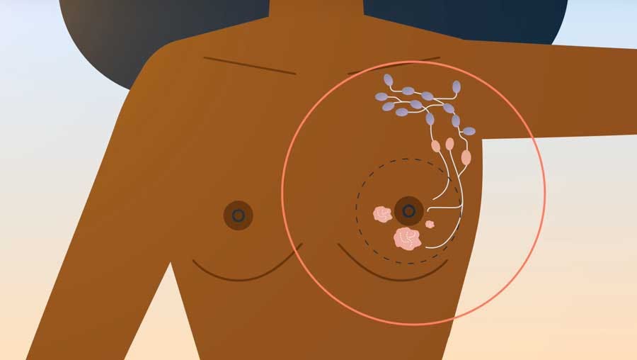 breast cancer lymph node illustration