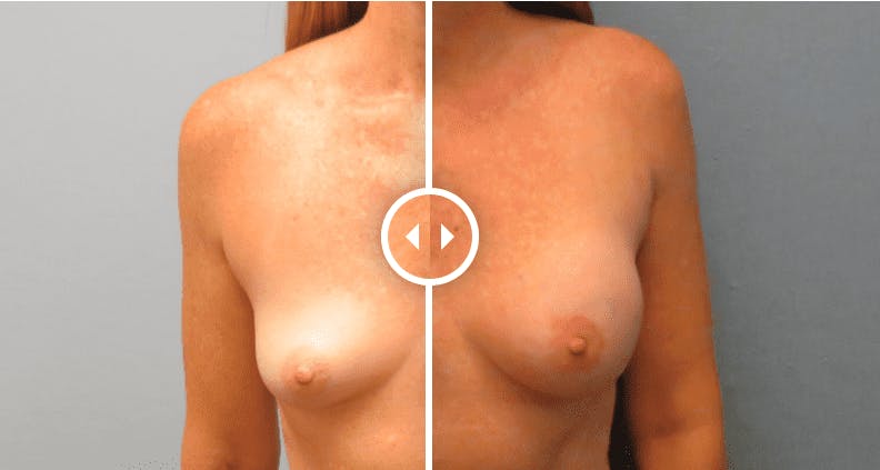 Before and after photo of skin-sparing mastectomy