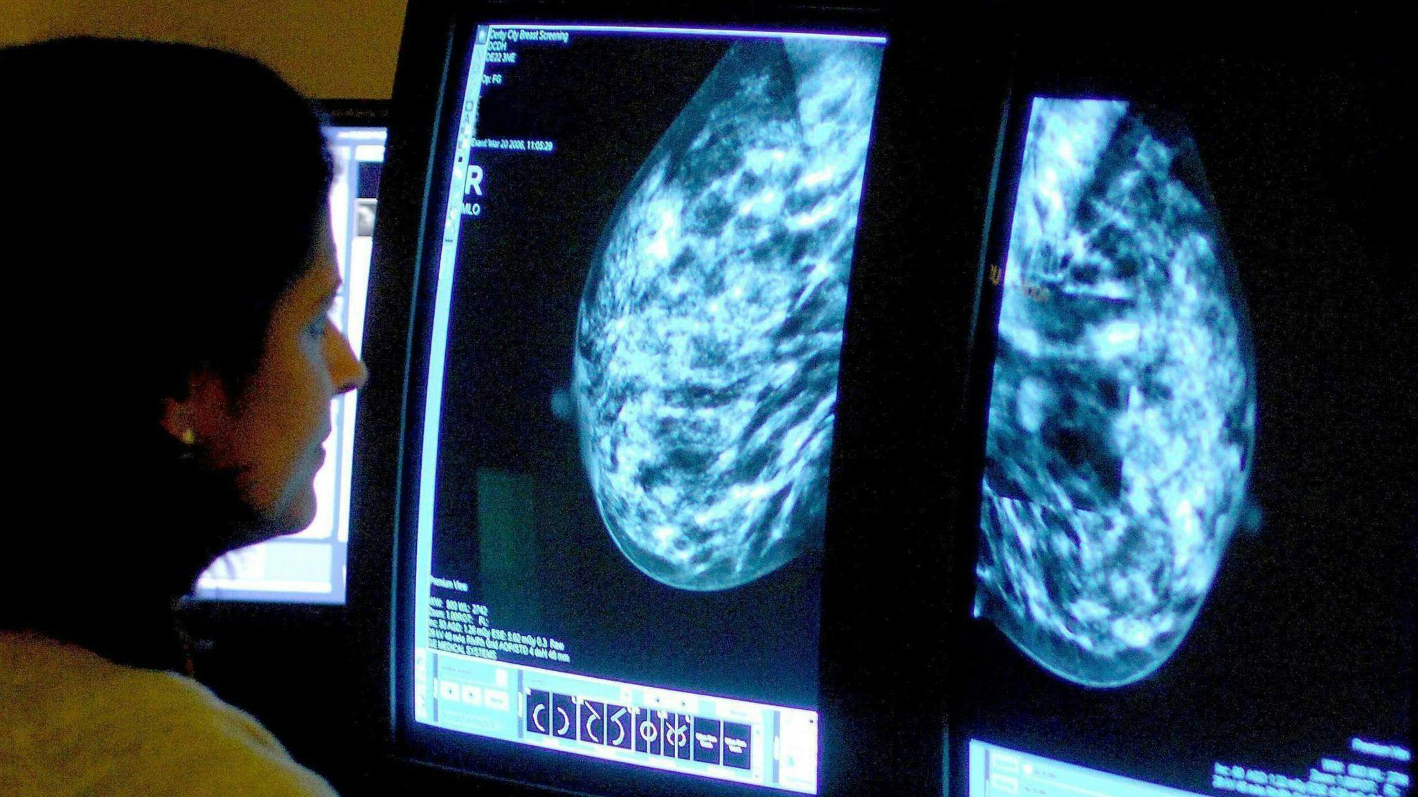 Mammogram images on screen